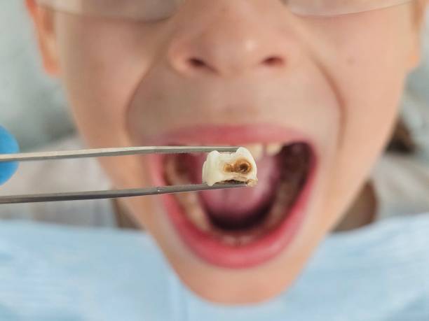 Best Emergency Tooth Extraction in New Concord, OH